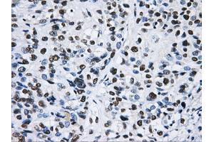 Immunohistochemical staining of paraffin-embedded Adenocarcinoma of ovary tissue using anti-HNRNPFmouse monoclonal antibody.