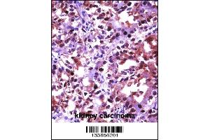 HSF1 Antibody immunohistochemistry analysis in formalin fixed and paraffin embedded human kidney carcinoma followed by peroxidase conjugation of the secondary antibody and DAB staining. (HSF1 antibody  (N-Term))