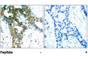 Immunohistochemical analysis of paraffin-embedded human breast carcinoma tissue using PAK1/PAK2/PAK3 polyclonal antibody . (PAK1 antibody)