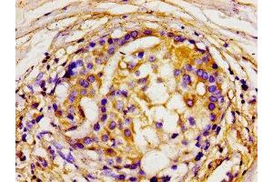 Immunohistochemistry of paraffin-embedded human breast cancer using ABIN7150072 at dilution of 1:100 (DLG2 antibody  (AA 310-420))