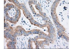 Immunohistochemical staining of paraffin-embedded Adenocarcinoma of Human colon tissue using anti-HIBCH mouse monoclonal antibody. (HIBCH antibody)