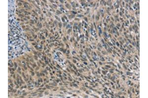The image on the left is immunohistochemistry of paraffin-embedded Human cervical cancer tissue using ABIN7190689(FOXF1 Antibody) at dilution 1/25, on the right is treated with synthetic peptide. (FOXF1 antibody)