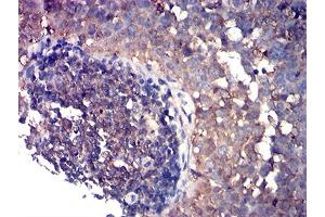 Immunohistochemical analysis of paraffin-embedded cervical cancer tissues using CD80 mouse mAb with DAB staining. (CD80 antibody  (AA 35-288))