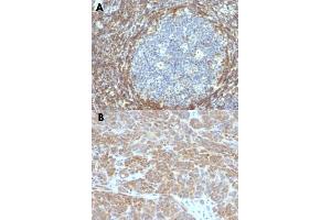 Immunohistochemical staining (Formalin-fixed paraffin-embedded sections) of human tonsil (A) and human melanoma (B) with BCL2 monoclonal antibody, clone BCL2/782 . (Bcl-2 antibody)