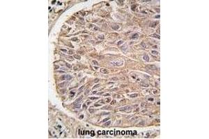 Formalin-fixed and paraffin-embedded human lung carcinoma tissue reacted with IKK beta antibody (ABIN1882097 and ABIN2842182) , which was peroxidase-conjugated to the secondary antibody, followed by DAB staining.