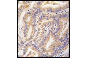 Formalin-fixed and paraffin-embedded human lung carcinoma tissue reacted with Autophagy APG12L Antibody (N-term), which was peroxidase-conjugated to the secondary antibody, followed by DAB staining. (ATG12 antibody  (N-Term))