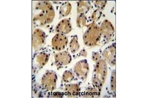 FAT10 Antibody (C-term) (ABIN655263 and ABIN2837857) immunohistochemistry analysis in formalin fixed and paraffin embedded human stomach carcinoma followed by peroxidase conjugation of the secondary antibody and DAB staining.