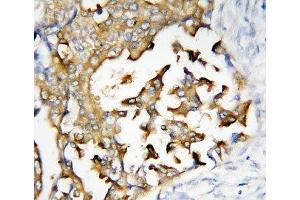 IHC-P: Presenilin 2 antibody testing of human breast cancer tissue (Presenilin 2 antibody  (N-Term))