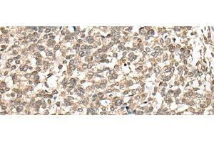 Immunohistochemistry of paraffin-embedded Human esophagus cancer tissue using PHF21A Polyclonal Antibody at dilution of 1:50(x200) (PHF21A antibody)