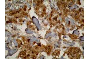 Immunohistochemistry staining of human prostate cancer tissue using CYP3A7 monoclonal antibody, clone F19 P2 H2 . (CYP3A7 antibody  (C-Term))