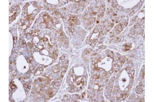 IHC-P Image Immunohistochemical analysis of paraffin-embedded NCIN87 xenograft , using MEKK8(COT), antibody at 1:500 dilution. (MAP3K8 antibody)