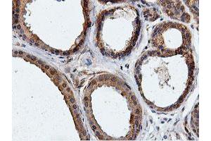 Immunohistochemical staining of paraffin-embedded Human breast tissue using anti-ILVBL mouse monoclonal antibody. (ILVBL antibody)