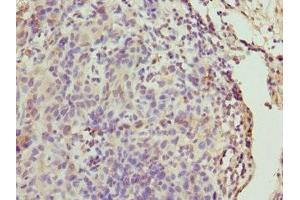 Immunohistochemistry of paraffin-embedded human bladder cancer using ABIN7146471 at dilution of 1:100 (Calmodulin 1 antibody  (AA 2-149))