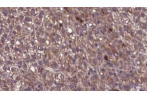 ABIN6276752 at 1/100 staining Human liver cancer tissue by IHC-P. (CHRM1 antibody  (C-Term))
