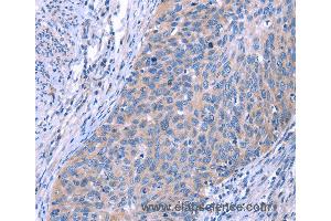 Immunohistochemistry of Human cervical cancer using ESPL1 Polyclonal Antibody at dilution of 1:40