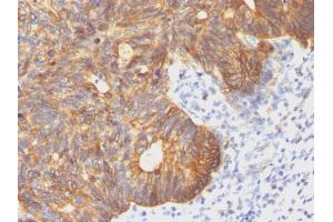 Formalin-fixed, paraffin-embedded human Colon Carcinoma stained with Cytokeratin 8 Mouse Monoclonal Antibody (C-43). (KRT8 antibody)