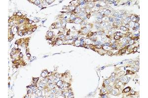 Immunohistochemistry of paraffin-embedded human liver cancer using MTOR antibody. (MTOR antibody)
