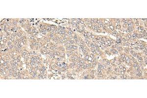 Immunohistochemistry of paraffin-embedded Human liver cancer tissue using C12orf40 Polyclonal Antibody at dilution of 1:50(x200) (C12orf40 antibody)