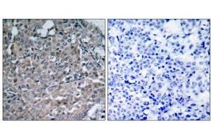 Immunohistochemical analysis of paraffin-embedded human breast carcinoma tissue using FAK (Ab-925) antibody (E021148). (FAK antibody)