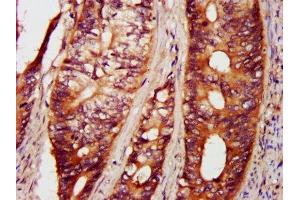 IHC image of ABIN7169132 diluted at 1:800 and staining in paraffin-embedded human colon cancer performed on a Leica BondTM system. (PAK4 antibody  (AA 1-426))