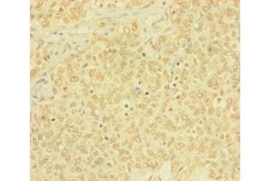 Immunohistochemistry of paraffin-embedded human ovarian cancer using ABIN7165146 at dilution of 1: 100 (BTG4 antibody  (AA 1-206))