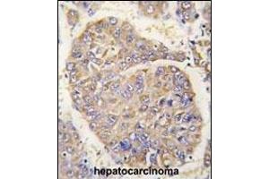 Formalin-fixed and paraffin-embedded human hepatocarcinoma tissue reacted with PBP antibody (N-term) (ABIN392674 and ABIN2842167) , which was peroxidase-conjugated to the secondary antibody, followed by DAB staining. (PEBP1 antibody  (N-Term))