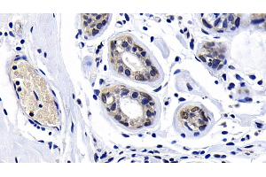 Detection of ATM in Human Breast cancer Tissue using Polyclonal Antibody to Ataxia Telangiectasia Mutated (ATM) (ATM antibody  (AA 2484-2748))