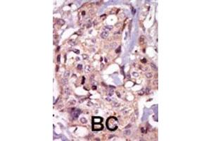 Formalin-fixed and paraffin-embedded human cancer tissue reacted with the primary antibody, which was peroxidase-conjugated to the secondary antibody, followed by AEC staining. (NR4A3 antibody  (AA 175-205))