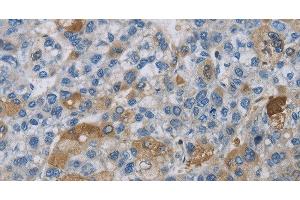 Immunohistochemistry of paraffin-embedded Human liver cancer using DNAJB4 Polyclonal Antibody at dilution of 1:50 (DNAJB4 antibody)
