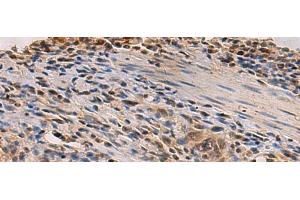 Immunohistochemistry of paraffin-embedded Human esophagus cancer tissue using PDS5B Polyclonal Antibody at dilution of 1:35(x200) (PDS5B antibody)