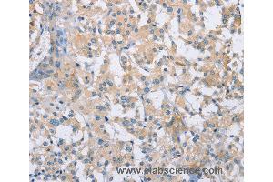 Immunohistochemistry of Human thyroid cancer using CDCP1 Polyclonal Antibody at dilution of 1:50