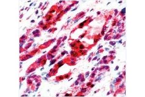 Formalin fixed paraffin embedded human angiosarcoma stained with Flk-1 antibody (VEGFR2/CD309 antibody  (C-Term))