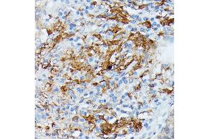 Immunohistochemistry of paraffin-embedded human lung cancer using RN antibody (ABIN7269987) at dilution of 1:100 (40x lens).