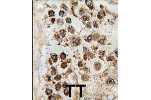 Formalin-fixed and paraffin-embedded human testis tissue reacted with MLLT10 antibody , which was peroxidase-conjugated to the secondary antibody, followed by DAB staining. (MLLT10 antibody  (C-Term))