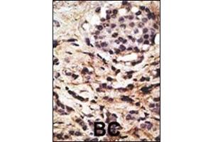 Formalin-fixed and paraffin-embedded human cancer tissue reacted with the primary antibody, which was peroxidase-conjugated to the secondary antibody, followed by DAB staining.