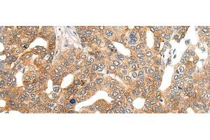 Immunohistochemistry of paraffin-embedded Human liver cancer tissue using HIPK2 Polyclonal Antibody at dilution of 1:40(x200) (HIPK2 antibody)