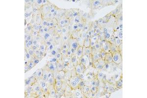 Immunohistochemistry of paraffin-embedded human liver cancer using ABCC1 Antibody (ABIN5971550) at dilution of 1/100 (40x lens). (ABCC1 antibody)