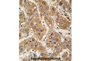Formalin-fixed and paraffin-embedded human hepatocarcinomareacted with APOE polyclonal antibody , which was peroxidase-conjugated to the secondary antibody, followed by AEC staining. (APOE antibody  (C-Term))