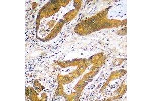Immunohistochemical analysis of USP48 staining in human colon cancer formalin fixed paraffin embedded tissue section. (USP48 antibody)