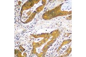 Immunohistochemical analysis of USP48 staining in human colon cancer formalin fixed paraffin embedded tissue section.
