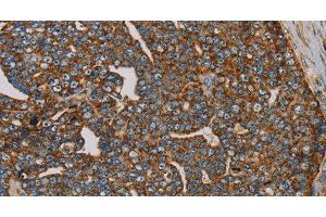 Immunohistochemistry of paraffin-embedded Human cervical cancer using MRPL28 Polyclonal Antibody at dilution of 1:45 (MRPL28 antibody)