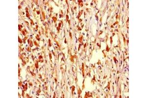 Immunohistochemistry of paraffin-embedded human melanoma using ABIN7162415 at dilution of 1:100 (NR1H2 antibody  (AA 1-461))