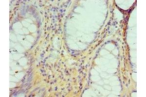 Immunohistochemistry of paraffin-embedded human colon cancer using ABIN7149566 at dilution of 1:100 (DIDO1 antibody  (AA 1-300))