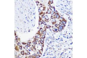 Immunohistochemistry of paraffin-embedded Human lung cancer using MTMR9 Rabbit pAb (ABIN6128253, ABIN6144163, ABIN6144164 and ABIN6217000) at dilution of 1:100 (40x lens). (MTMR9 antibody  (AA 1-250))