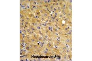 DLG7 Antibody (Center) (ABIN650734 and ABIN2839433) IHC analysis in formalin fixed and paraffin embedded hepatocarcinoma followed by peroxidase conjugation of the secondary antibody and DAB staining. (DLGAP5 antibody  (AA 228-258))