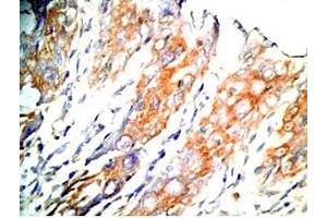 Human colon cancer tissue was stained by Rabbit Anti-GLP-1 (2-24) (Human) Antibody (GLP-1 antibody  (AA 2-24))