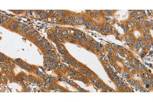Immunohistochemistry of paraffin-embedded Human gastric cancer tissue using PI 3 Kinase Class 3 Polyclonal Antibody at dilution 1:40 (PIK3C3 antibody)
