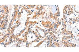 Immunohistochemistry of paraffin-embedded Human thyroid cancer tissue using ACSBG1 Polyclonal Antibody at dilution 1:40 (ACSBG1 antibody)