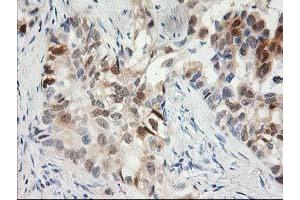 Immunohistochemical staining of paraffin-embedded Carcinoma of Human lung tissue using anti-HPGD mouse monoclonal antibody. (HPGD antibody)