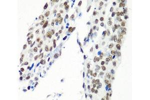 Immunohistochemistry of paraffin-embedded Human lung cancer using HTATSF1 Polyclonal Antibody at dilution of 1:100 (40x lens). (HTATSF1 antibody)